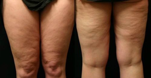 Lipedema, a síndrome das pernas gordas