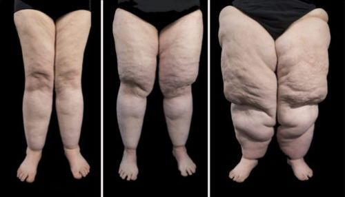 Lipedema, a síndrome das pernas gordas