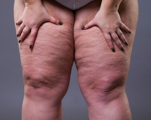 Lipedema, a síndrome das pernas gordas