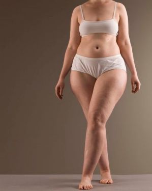 Lipedema, a síndrome das pernas gordas