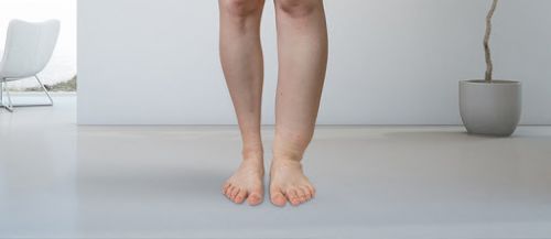 Linfedema: o que é e como fazer o diagnóstico e tratar