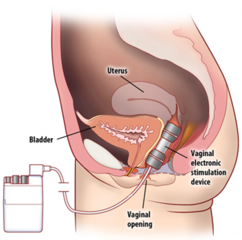 Eletroestimulação Uroginecológica